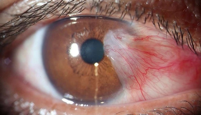 CIRURGIA DE PTERíGIO